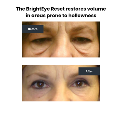 BrightEye Reset™